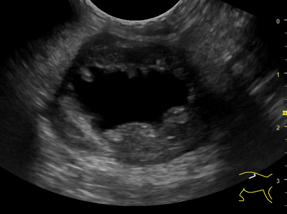 腎嚢胞の超音波画像